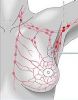 Cncer de mama: Algunos tumores no requieren remocin de los ndulos linfticos